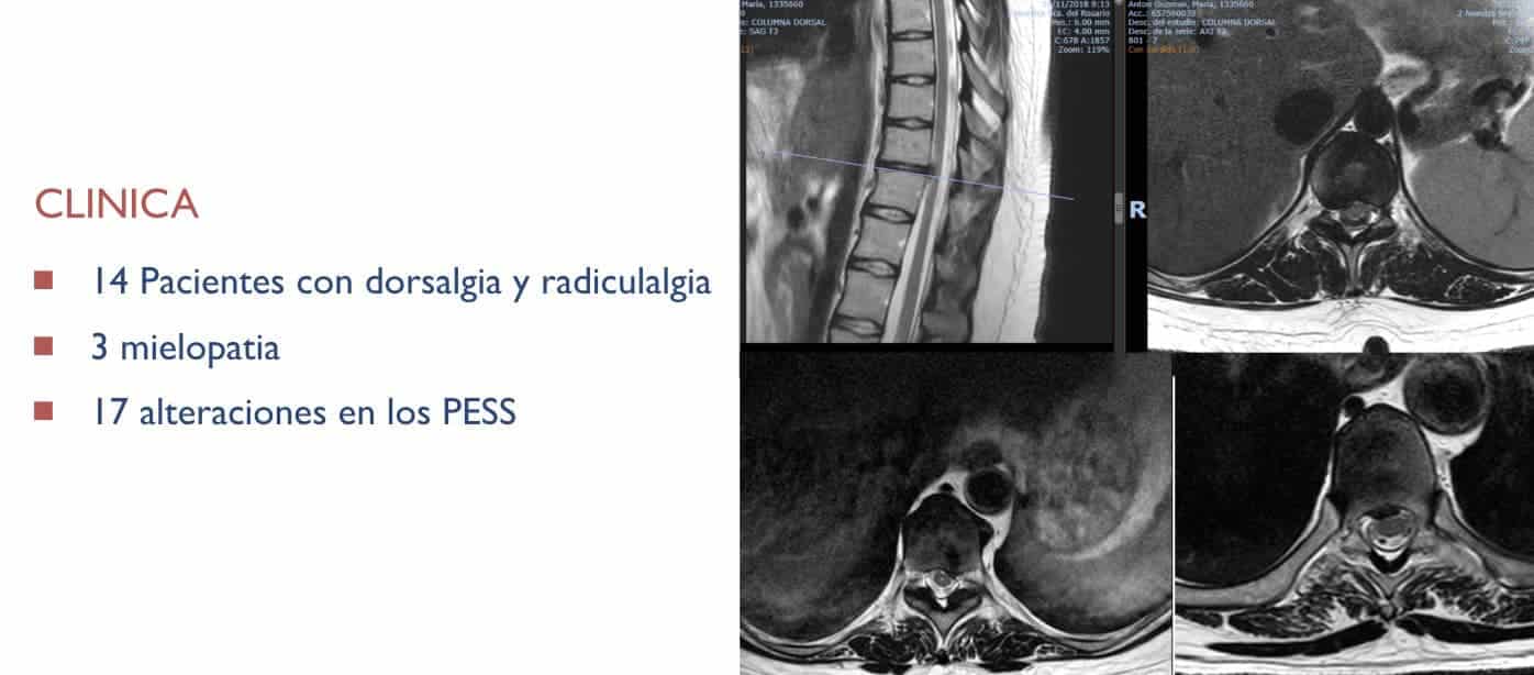 De los 17 pacientes 14 presentaron dorsalgia con dolor radicular. En 3 casos tenían mielopatía. Todos ellos tenial alteraciones en los potenciales somatosensoriales previos a la intervención