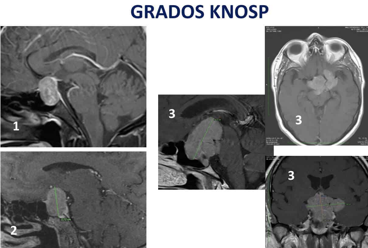 Figura 14-adenoma de hipofisis-diagnostico