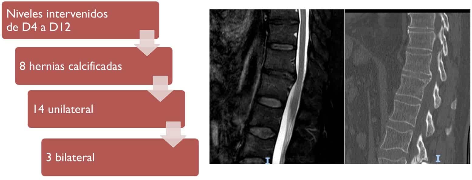 En 8 casos la hernia estaba calcificada. En 3 pacientes hicimos un abordaje bilateral mientras que en 14 solo unilateral . Importante realizar en los estudios preoperatorios además de la resonancia un TAC que nos puede indicar el grado de calcificación del disco así como servir para la localización intraoperatoria