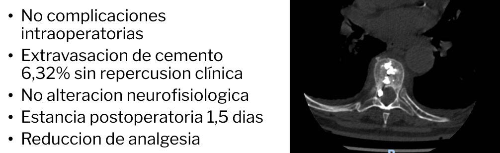 No hemos tenido complicaciones intraoperatorias, En un 6,32% de los casos el cemento se extravaso del cuerpo pero sin repercusión clínica ni alteración en la monitorización neurofisiológca. La estancia postoperatoria es de 1,5 días. En todos los casos se ha reducido la medicación analgésica.