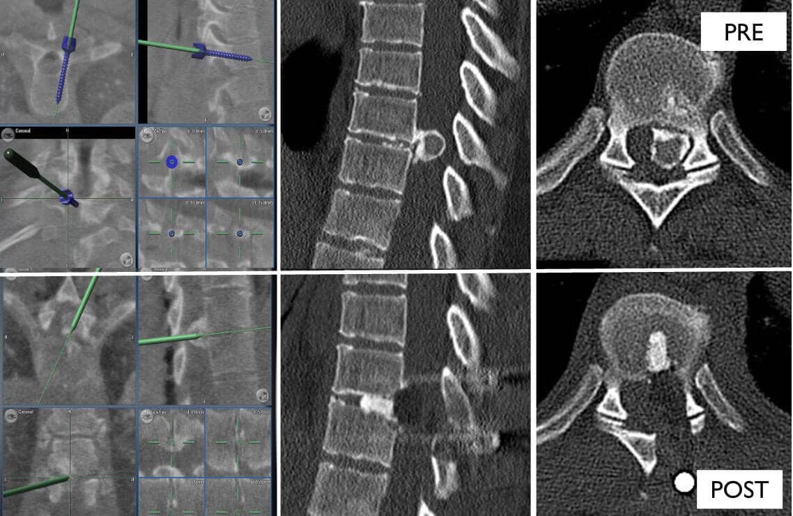 16 TRANSFACETARIO UNILATERAL- Imágenes del mismo paciente intraoperatorias con el navegador para colocar los tornillos y para guiar la disección. Las imágenes inferiores son los controles postoperatorio