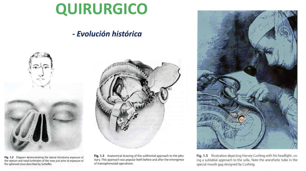 Figura 17-adenoma de hipofisis-tratamiento