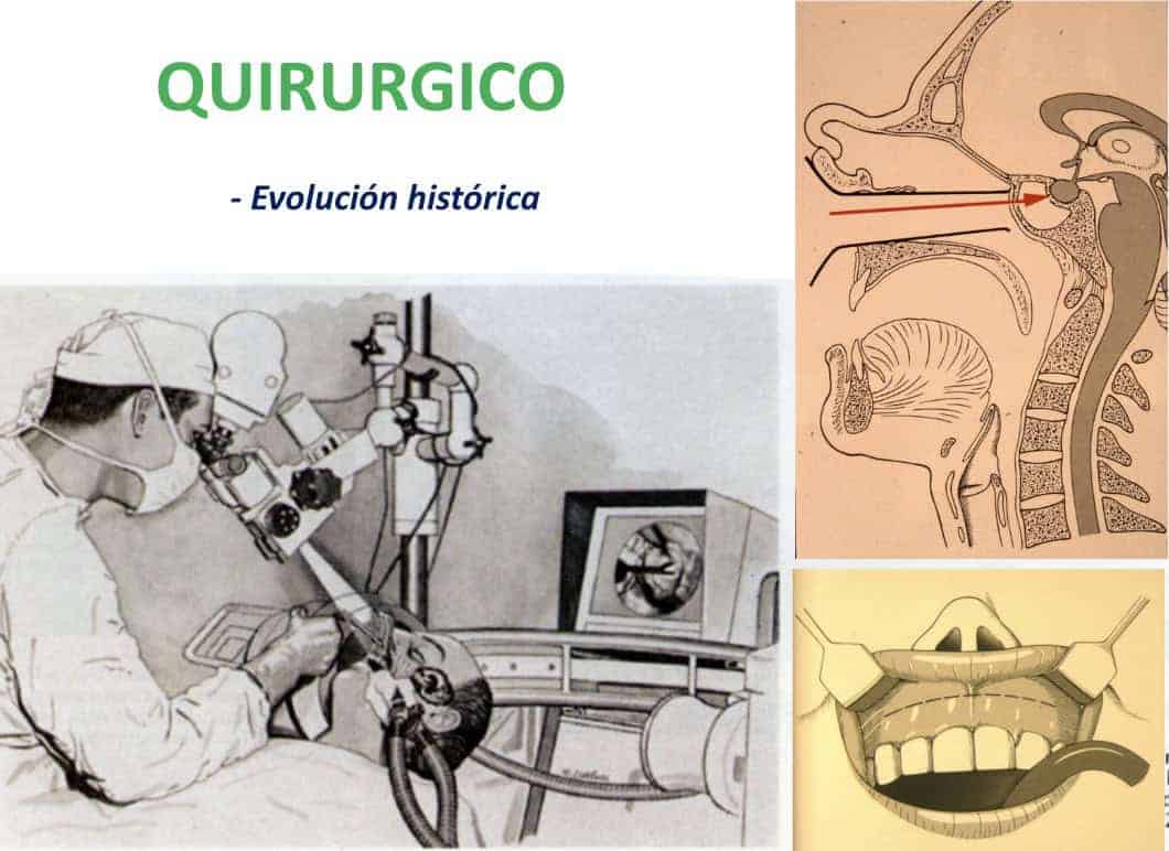 Figura 18-adenoma de hipofisis-tratamiento