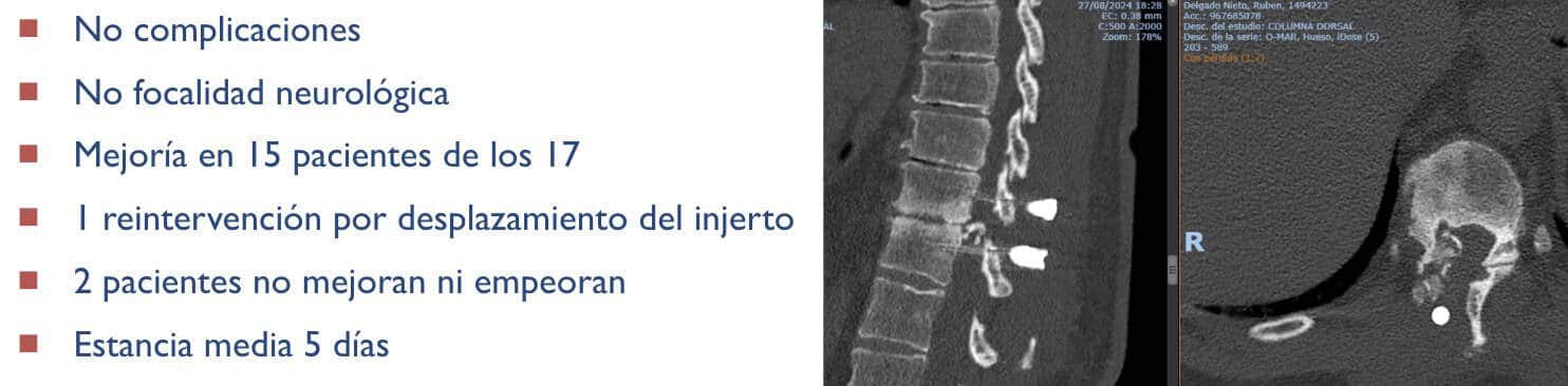 resultados-No hemos tenido complicaciones ni focalidad neurológica. 15 de los 17 pacientes mejoraron sus síntomas.