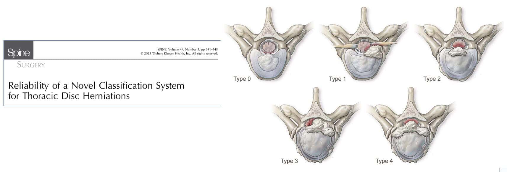 Recientemente se ha publicado un artículo para clasificar los tipos de hernia discal dorsal y sus posibles abordajes.