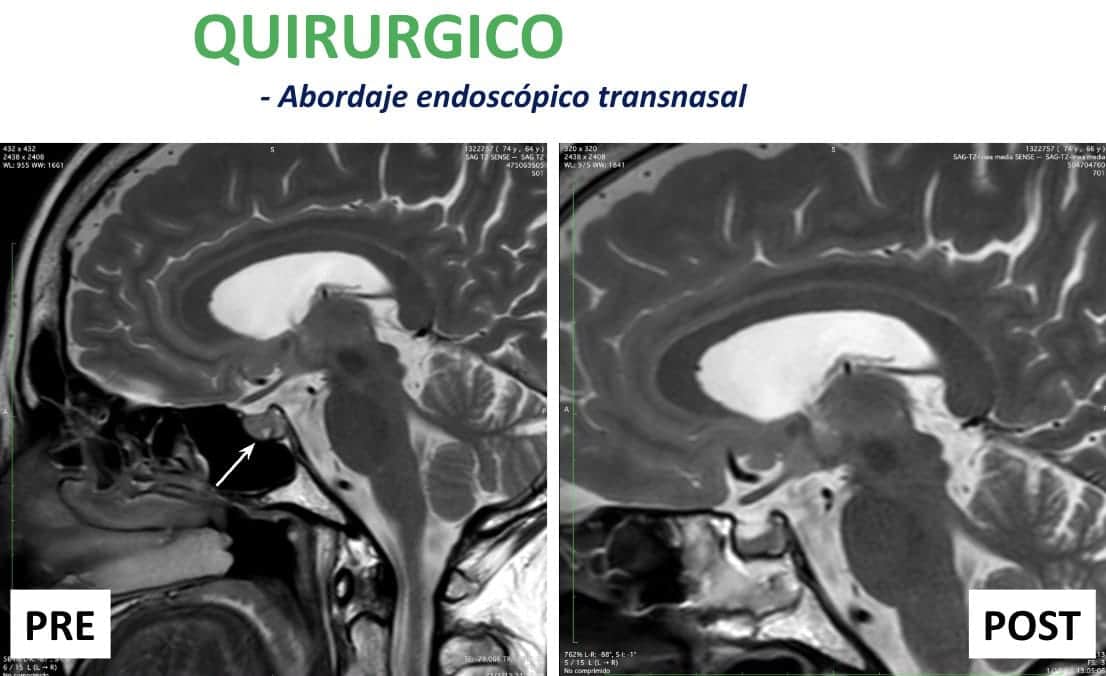 Figura 23-adenoma de hipofisis-tratamiento