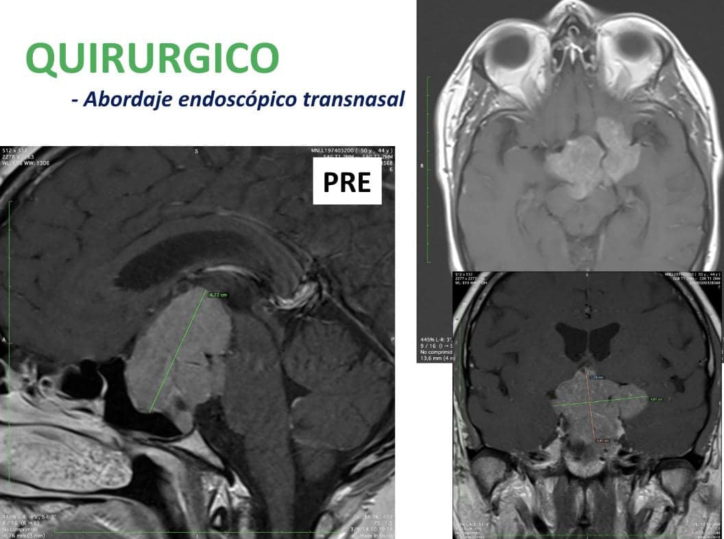 Figura 26-adenoma de hipofisis-tratamiento