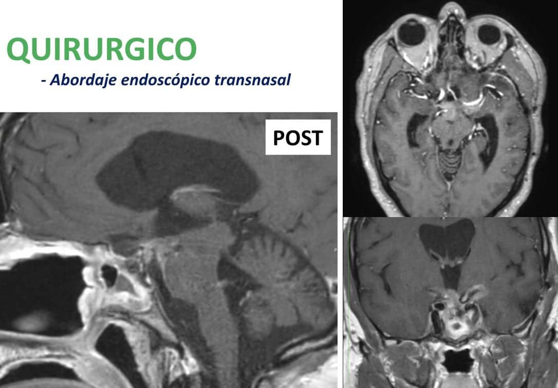 Figura 27-imágenes postquirúrgicas y post-radioterapia del mismo paciente