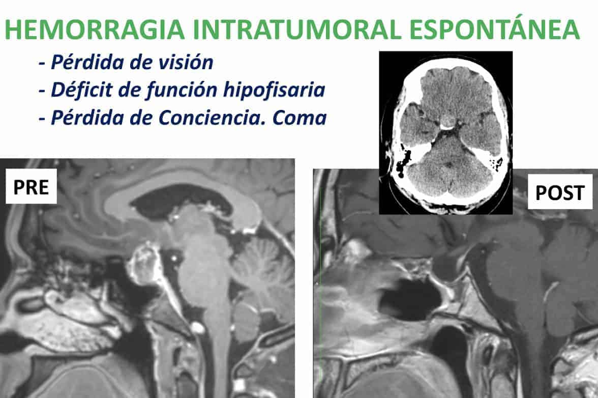 Figura 28-adenoma de hipofisis-apoplejia-hipofisaria