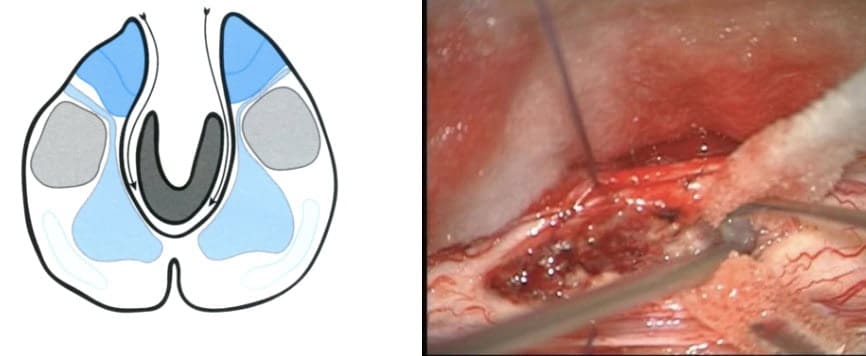 Tumores intramedulares-Separación de la parte más anterior del tumor de las astas anteriores medulares