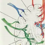 Tratamiento de anginoma cavernoso-cavernomas