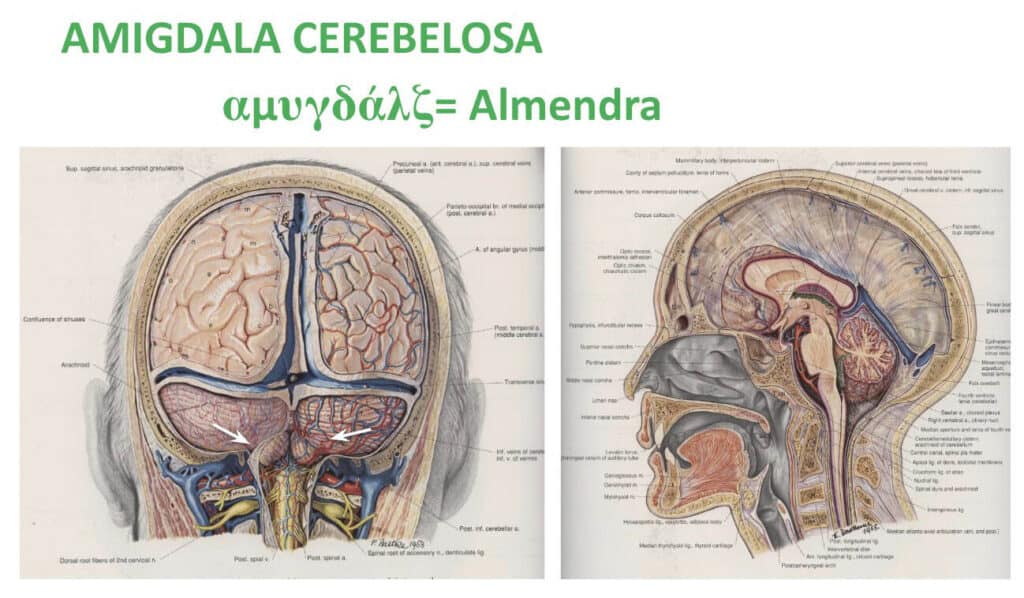 Malformación de Chiari tipo I Tratamiento quirúrgico Unidad de — free download