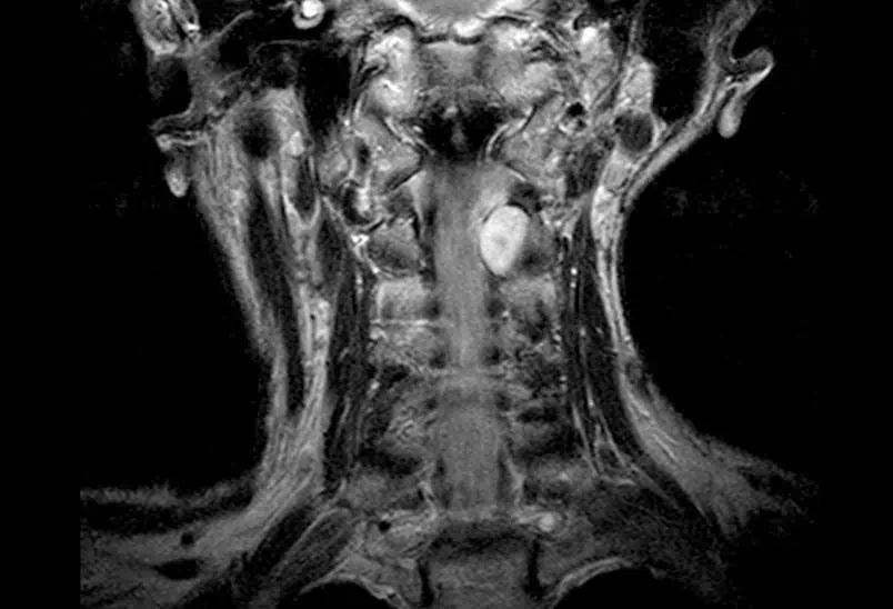 Figura 14.- sindrome de compresion medular-fase radicular-Tumores Intradurales Extramedulares