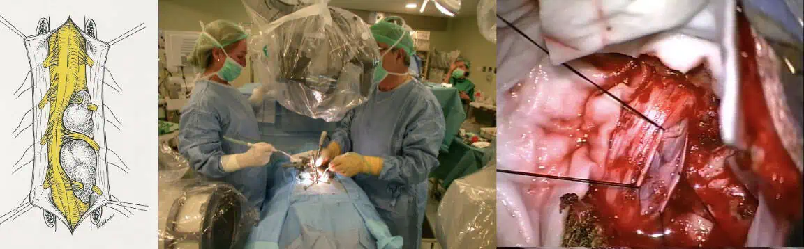 Figura 37.- TRATAMIENTO QUIRURGICO Apertura de Duramadre-MICROCIRUGIA - neurofisiología intraoperatoria-Tumores Intradurales Extramedulares