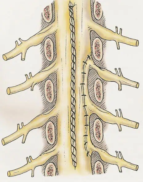 Figura 39.- TRATAMIENTO QUIRURGICO Cierre dural con plastia de duramadre - Anatomía Patológica.