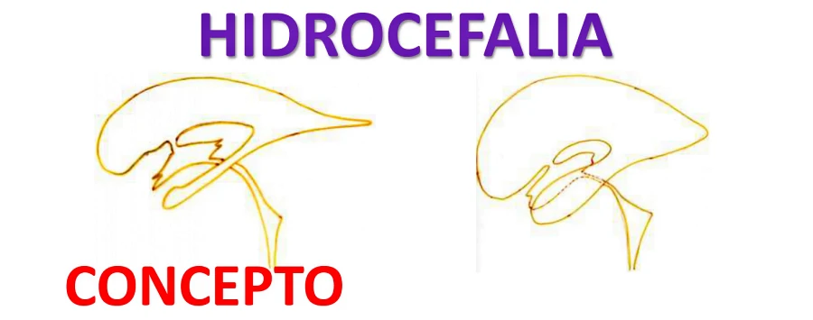 Figura 04.- HIDROCEFALIA concepto
