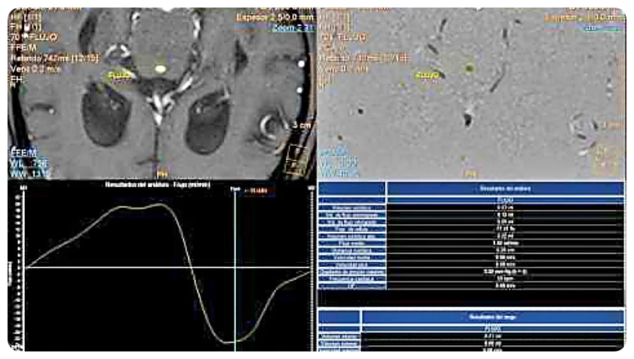 Figura 10b-diagnostico-indice-evans-tile