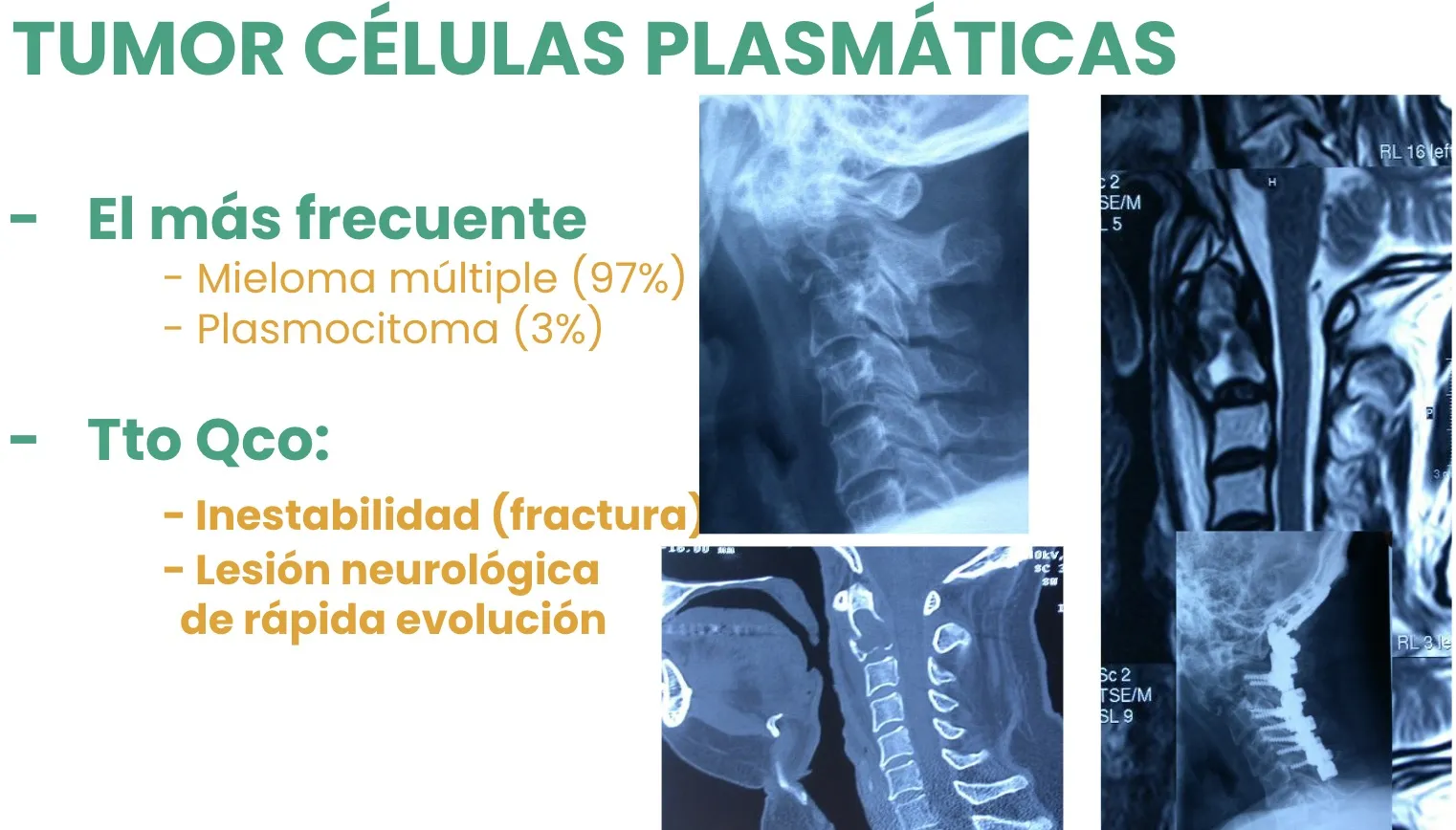 Figura 10.- Tumores malignos - Tumores de células plasmáticas
