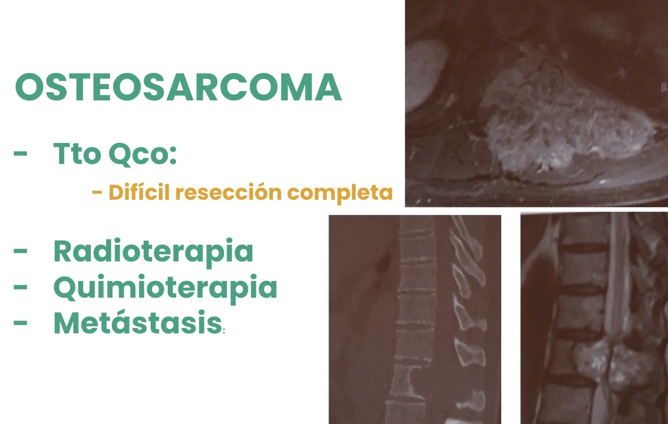 Figura 12.- Tumores malignos primarios - Osteosarcoma