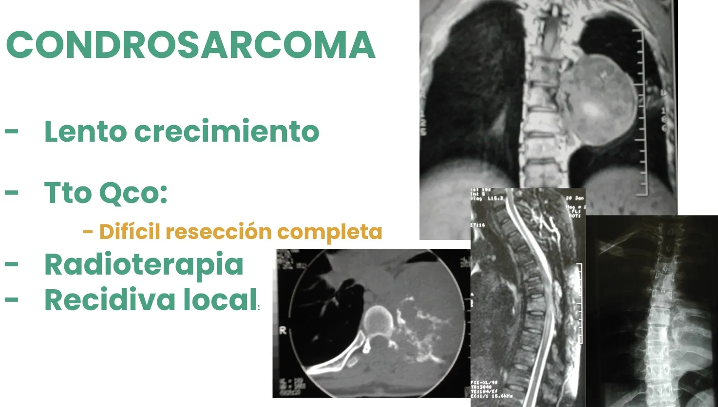 Figura 13.- Tumores malignos primarios - Condrosarcoma