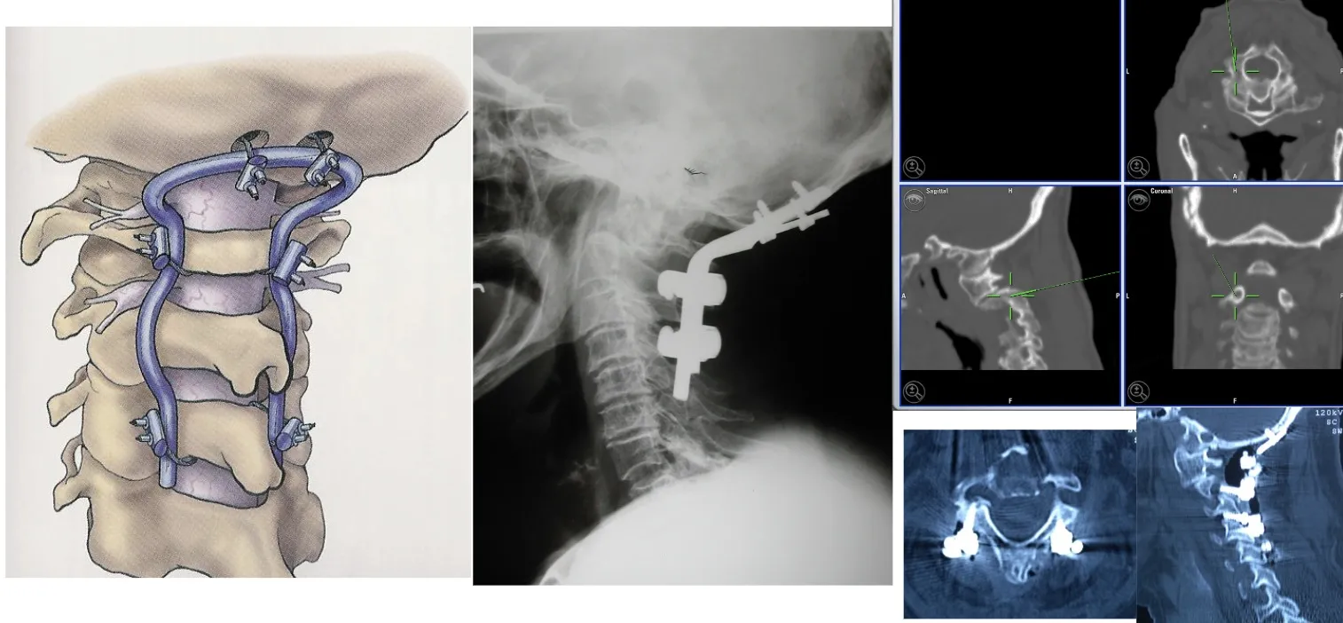 Figura 18.- Tratamiento quirúrgico - Fijación Occipito Cervical