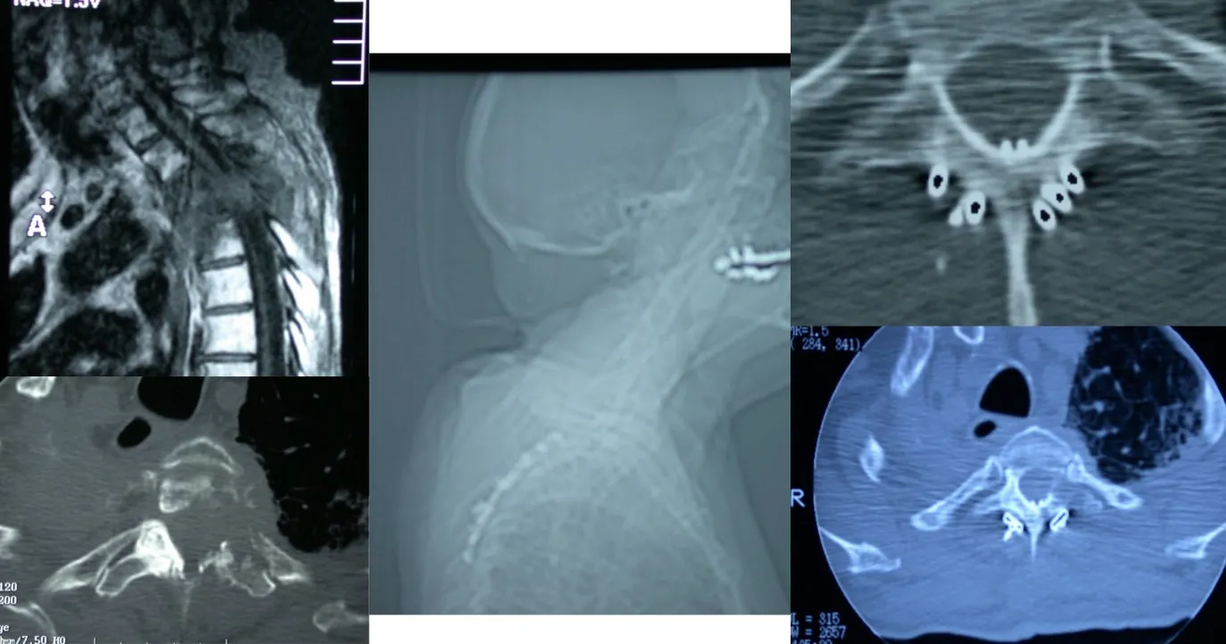 Figura 22.- Tratamiento quirúrgico - Charnela Cérvico-Torácica - Fijación posterior