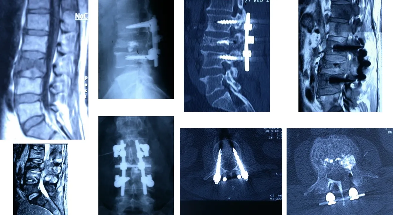 Figura 27.- Tratamiento quirúrgico - Vertebroplastia - Cifoplastia