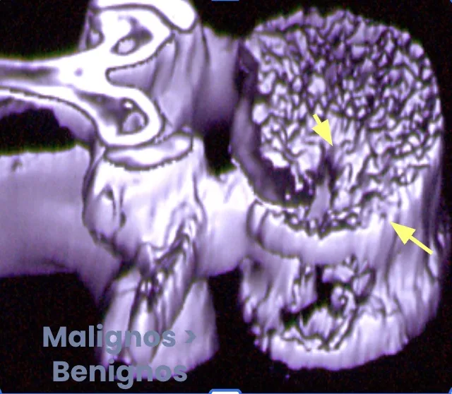 Figura 3.- Tumores primarios -malignos - benignos