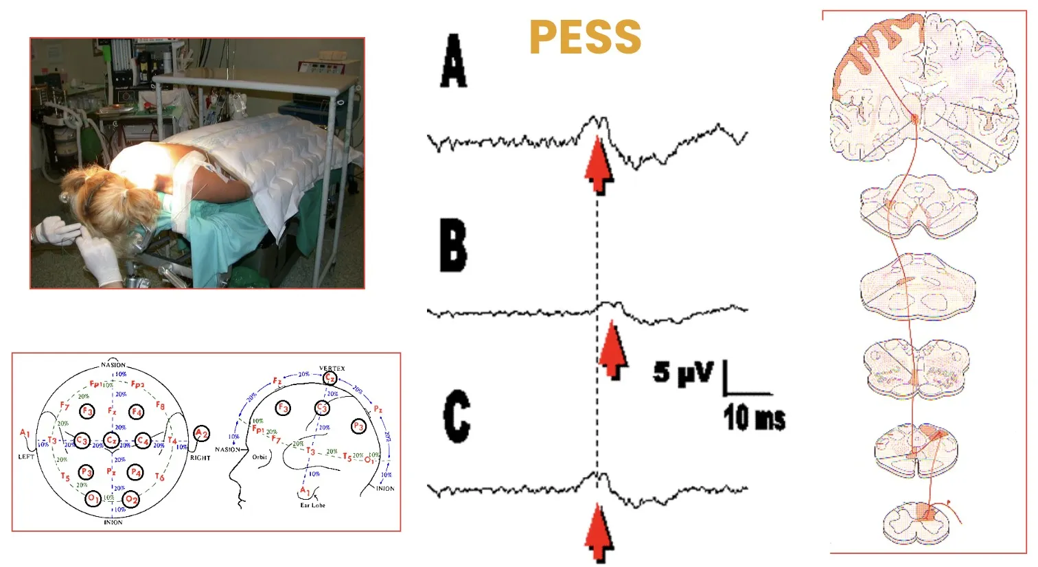Figura 34.- Equipamiento neuroquirúrgico - Neurofisiología intraoperativa - Potenciales evocados PESS