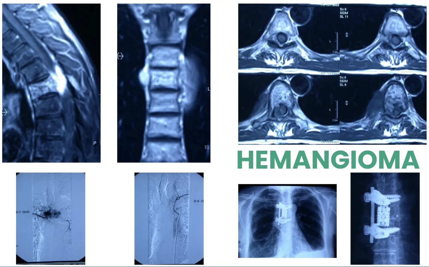 Figura 6.- Tumores benignos - Hemangioma