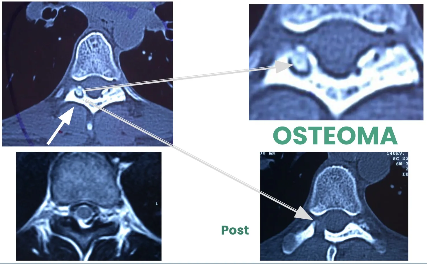 Figura 7.- Tumores benignos - Osteoma