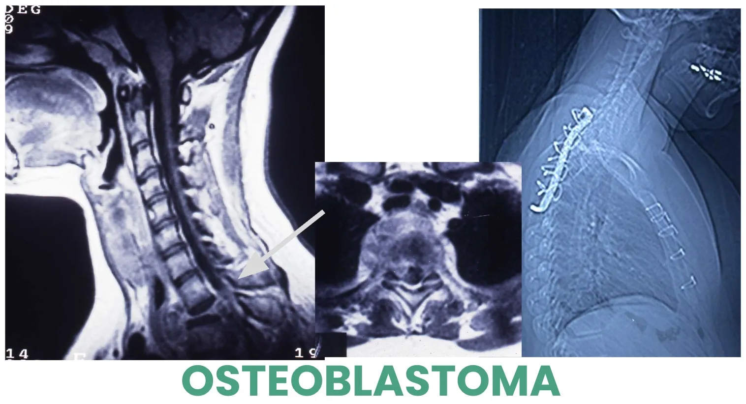 Figura 8.- Tumores benignos - Osteoblastoma