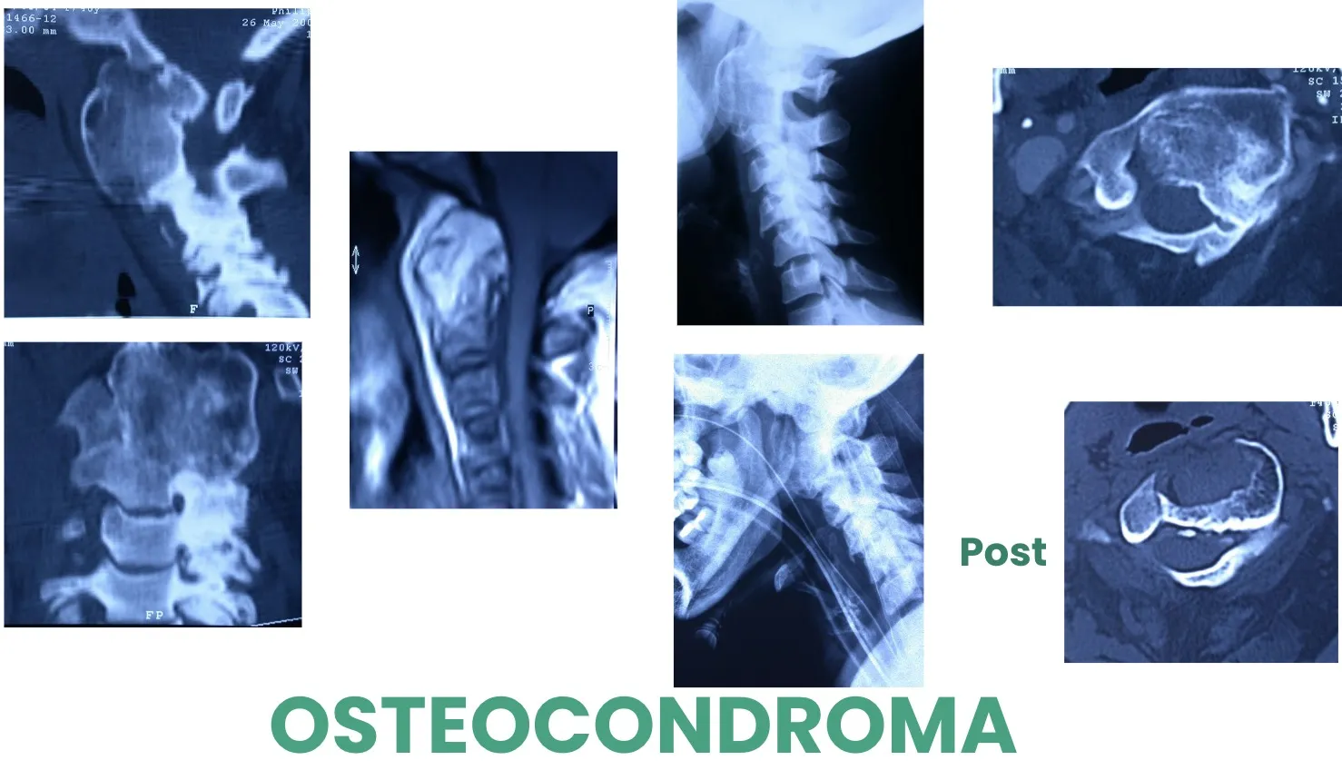 Figura 9.- Tumores benignos - Osteocondroma