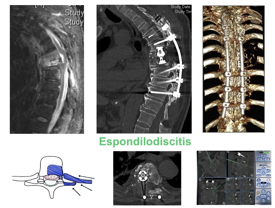 Figura 1.- Abordaje torácico posterolateral en espondilodiscitis. Secuencia completa desde resonancia magnética preoperatoria, TAC de control, reconstrucción 3D de la instrumentación, imagen axial y navegación quirúrgica.