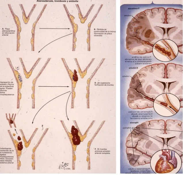 Tipos de ictus isquémico: mecanismos de obstrucción arterial progresiva y embolia cerebral