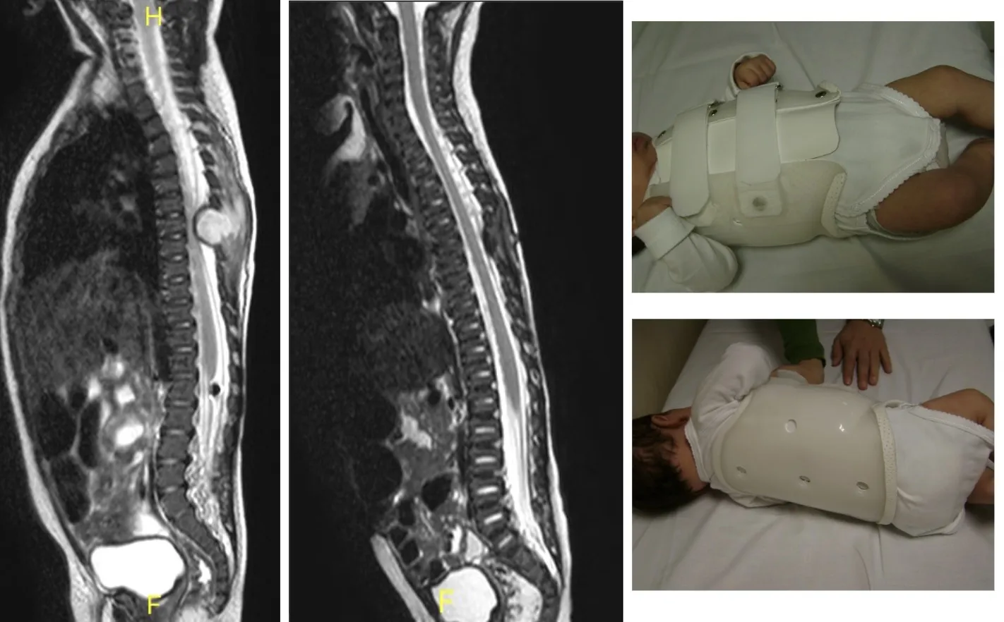 Espondilodiscitis en lactante. Resonancias magnéticas de control y fotografías del corsé ortopédico utilizado para el tratamiento conservador.