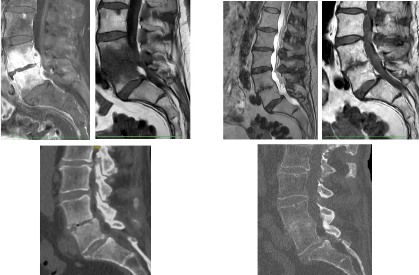 Espondilodiscitis postquirúrgica por inoculación externa. Serie de resonancias magnéticas mostrando la evolución de la infección tras procedimiento quirúrgico.