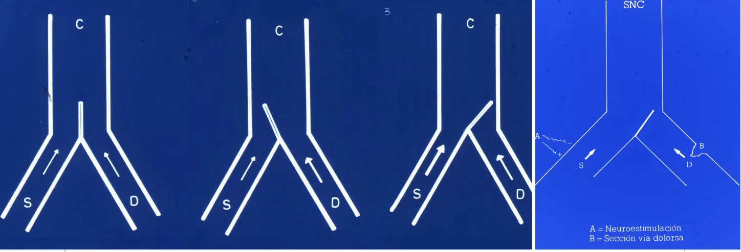 Esquema de la teoría de la compuerta del dolor. El diagrama muestra cómo el sistema nervioso puede modular el dolor mediante dos mecanismos: A) Neuroestimulación que aumenta las aferencias sensitivas, y B) Sección de la vía dolorosa que bloquea las señales de dolor.