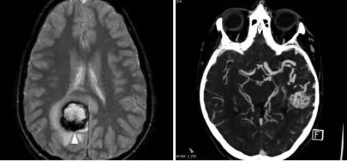 Ictus hemorrágico vs. ictus isquémico: imágenes de resonancia magnética y angio-TAC mostrando las diferentes patologías