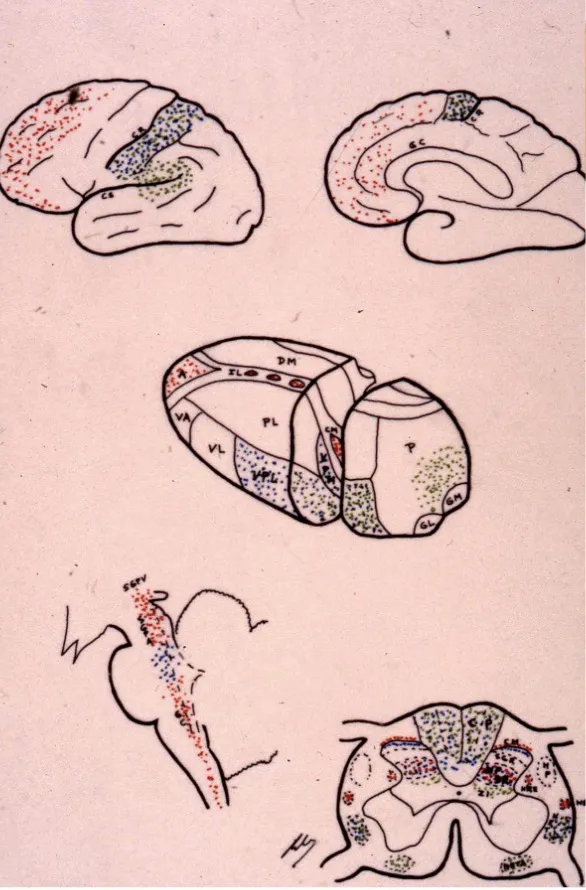 Estadio III de Hendler: dolor crónico de 6 meses a 8 años, depresión y angustia, hostil hacia médico y cuidadores, dependencia, ya hay fracasos terapéuticos, abandona familia/sociedad/trabajo. Vías: paleo espino-talámico, sustancia reticular, hipotálamo, sistema límbico. Imágenes de reorganización cerebral.