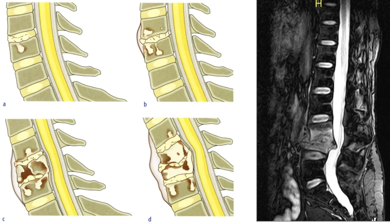 Evolución del colapso vertebral e inestabilidad. Esquemas ilustrativos de la progresión de la destrucción discal y vertebral, junto con resonancia magnética mostrando cifosis patológica.