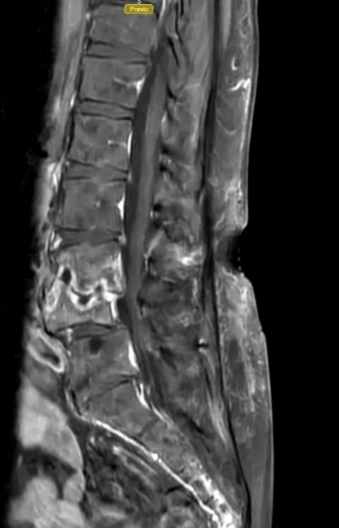 Manifestaciones clínicas de la espondilodiscitis. Resonancia magnética lumbar mostrando afectación discal y edema vertebral extenso.