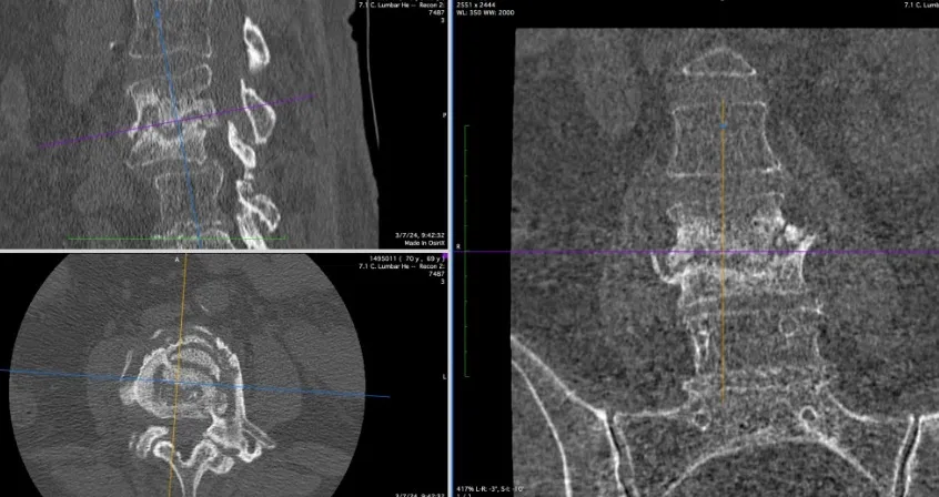 Formas clínicas de presentación. Múltiples cortes de TAC mostrando diferentes patrones de afectación vertebral según la forma de presentación.