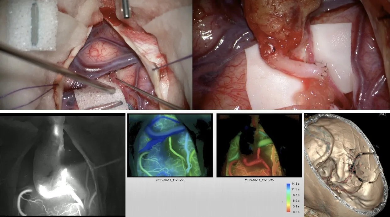 Control intraoperatorio del clipaje de aneurisma mediante fluorescencia con verde indocianina: imágenes quirúrgicas y angiografía intraoperatoria