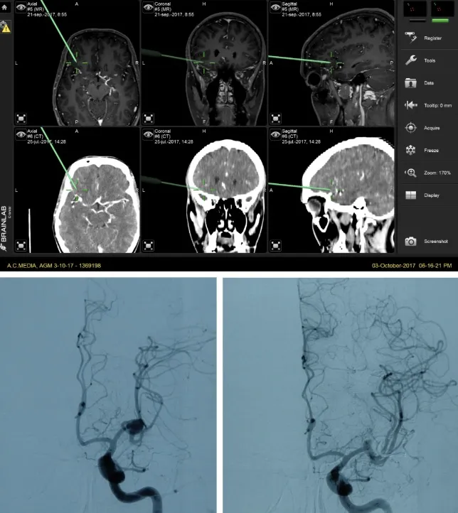 Control intraoperatorio con neuronavegador: planificación tridimensional y arteriografía pre y postoperatoria del clipaje