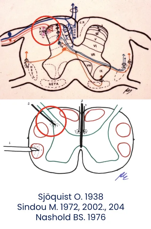 Técnica DREZ (Dorsal Root Entry Zone) para el tratamiento del dolor por desaferentización. Indicada en avulsión del plexo braquial, lesión medular segmentaria, amputación, herpes zóster y tumor de Pancoast. Requiere control neurofisiológico intraoperatorio. Desarrollada por Sjöquist en 1938, Sindou en 1972 y Nashold en 1976.