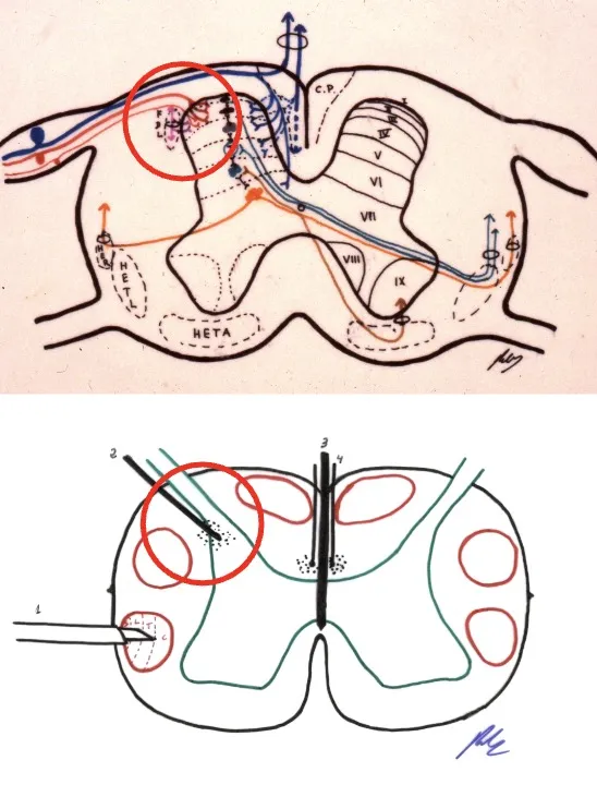 Evidencia científica sobre la técnica DREZ. Revisión de Gadgil publicada en Stereotactic and Functional Neurosurgery en 2012, que analizó 14 publicaciones con 123 pacientes, demostrando buenos resultados en el tratamiento del dolor neuropático.