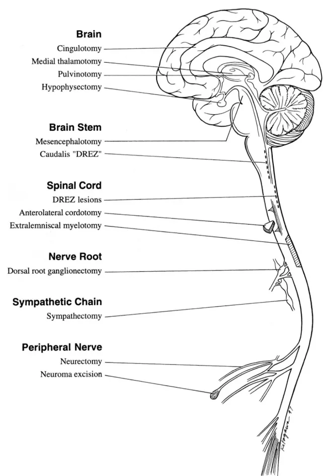 Tratamiento quirúrgico mediante lesión: neurectomía periférica, rizotomía, cordotomía, mielotomía, tractotomía mesencefálica, DREZ, talamotomía medial, cingulotomía. Diagrama anatómico completo mostrando cerebro, tronco cerebral, médula espinal, raíces nerviosas y cadena simpática. Indicaciones: nocicepción versus desaferentización.