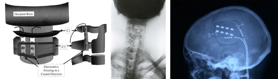 Tratamiento quirúrgico mediante neuroestimulación: radicular-nervio periférico, medular (cordones posteriores), hipotálamo, tálamo (VPM-VPL, PAG-PVG), córtex motor. Imágenes de radiografía de columna con electrodo medular y TAC cerebral con electrodos talámicos. Indicaciones: nocicepción versus desaferentización.