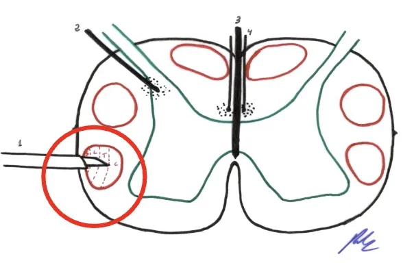 Grandes series publicadas sobre cordotomía percutánea: France et al. 2014 (revisión de 160 pacientes), Kanpolat et al. 2013 (224 pacientes entre 1987-2012), Bain et al. 2013 (45 pacientes). Además, Bentley et al. 2014 demostraron aumento de eficacia cuando se combina con morfina intratecal.